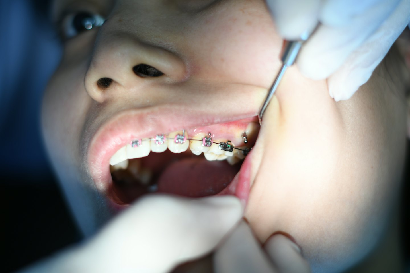Mani guantate di un dentista che aggiustano un apparecchio sui denti di un paziente.
